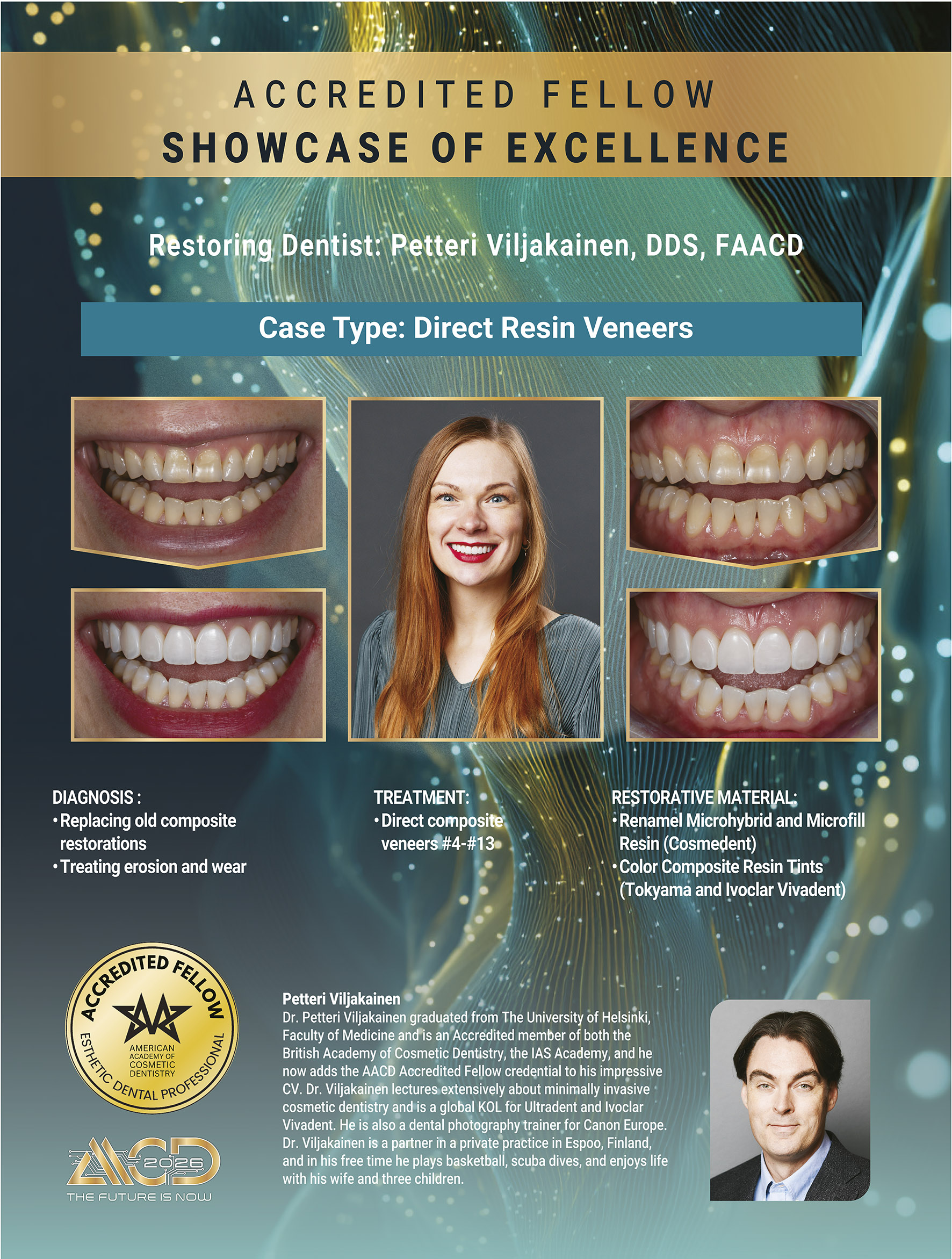 Reunimmaisessa yläetuhampaassa Invisalign oikomisen jälkeen yksittäinen keraaminen kuori eli hammaslaminaatti.